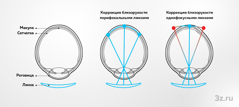 Схема работы перифокальных линз