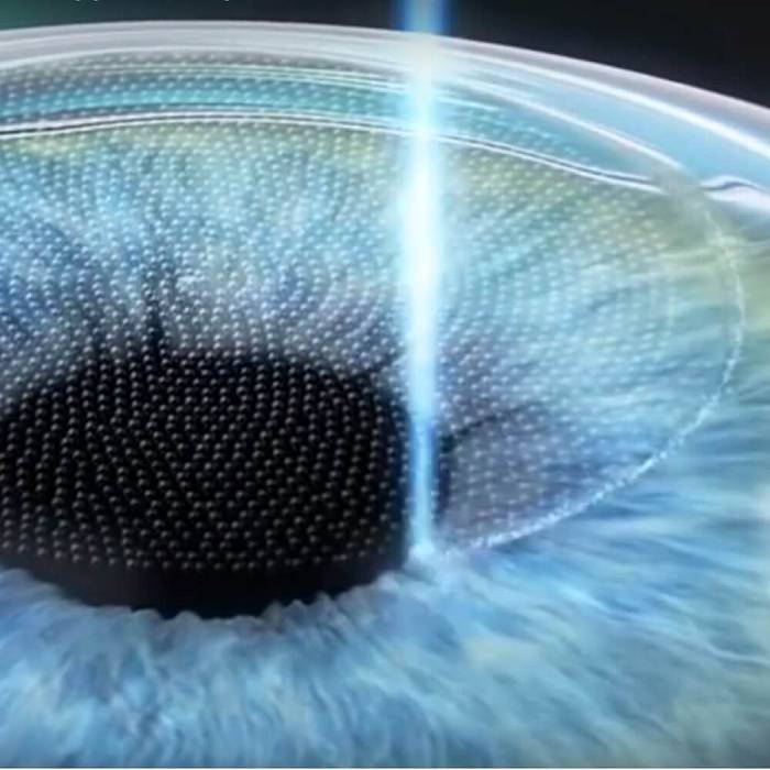Femto Super LASIK